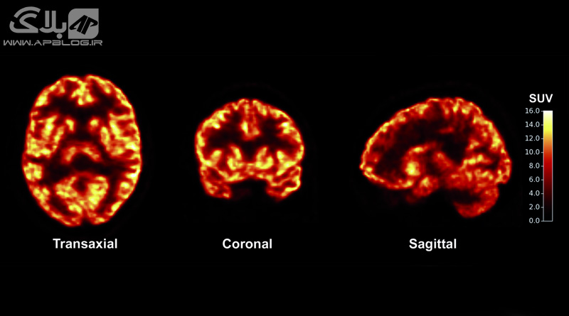 You are currently viewing روش جدید اسکن تغییرات مغزی ناشی از بیماری هایی نظیر آلزایمر